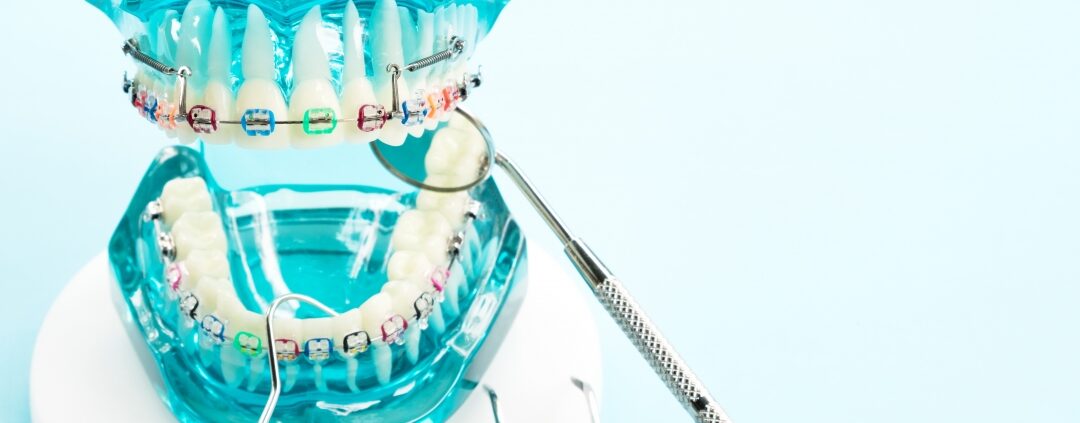 Understanding the Stages of an Orthodontic Treatment in Guelph