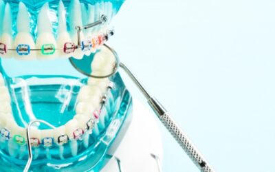 Understanding the Stages of an Orthodontic Treatment in Guelph